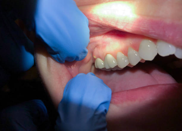 Best Chipped Tooth Repair Near Me  in Creston, IA